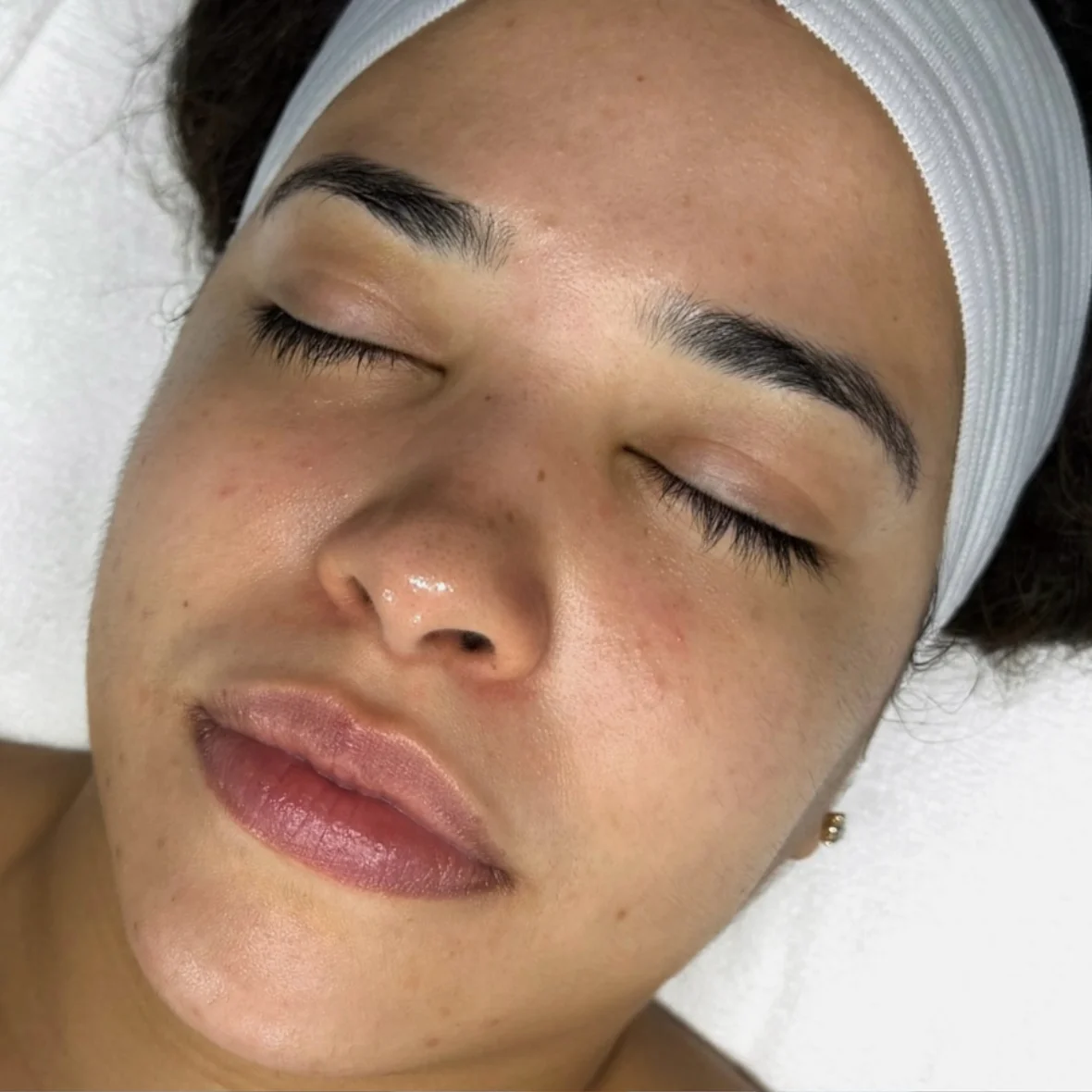 Facial Before Picture